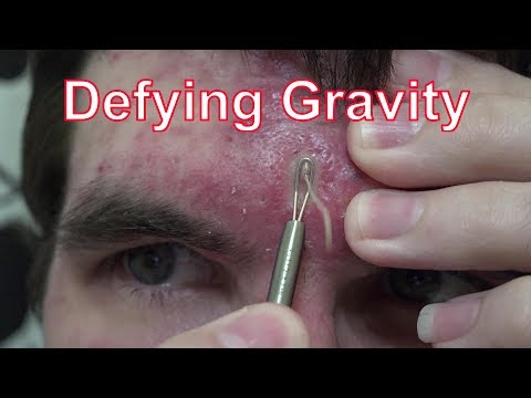 Night Of The Living Squirts | Life With Cystic Acne Documentary #