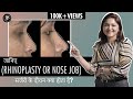 Know what happens during Rhinoplasty Surgery (Nose Job) | Nose Surgery Before and After (हिंदी में)