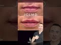 Plastic Surgeon Reacts to his Lip Filler Results | Dr. Johnson C. Lee | Beverly Hills, CA