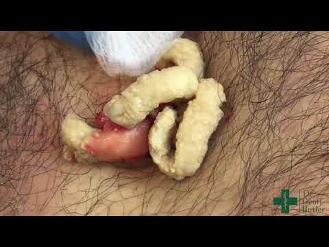 Removal of a large epidermal cyst along the mid-chest