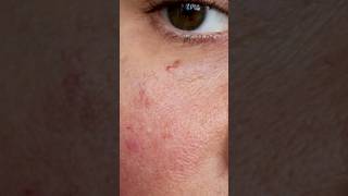 Skincare Gone Wrong! Tips to heal! #skincare #antiaging #skincareroutine #skinbarrier