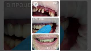 Теперь я могу показать себя и это лучший в жизни момент. Имплантация зубов.