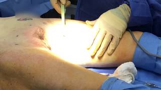 BodyTite Los Angeles For Inner Thigh Skin Laxity - Not A Thigh Lift Dr. Kenneth Hughes BodyTite Los Angeles For Inner Thigh Skin Laxity - Not A Thigh Lift Dr. Kenneth Hughes