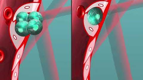 Animation of single and clustered tumor cells extravasating through angiopellosis