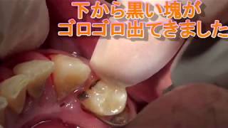 上尾　歯医者　歯周病　歯石取り　上の歯の歯茎の下に潜む黒い歯石　　Invisible tartar under the gums,Remove tartar