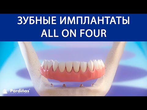 Зубные имплантаты «All on 4» ©