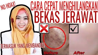 Skincare utk Bruntusan & Tekstur Gradakan (Oily & Acne Prone Skin)