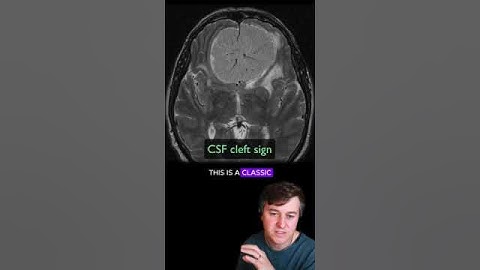 Intra- versus extra-axiale hersentumor