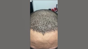 11 Ngày Cấy Tóc Trị Hói M Thành Công? KINH NGHIỆM CẤY TÓC #caytoc #caytoctuthan #hairtransplant