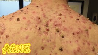 Acne Vulgaris!  World's Worst Acne!   Real and Fake