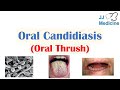 Oral candidiasis oral thrush  causes pathophysiology signs  symptoms diagnosis treatment
