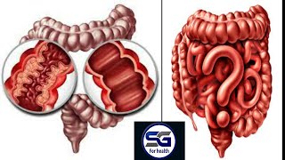 التهاب القولون التقرحي والمستقيم أسبابه، أعراضه وطرق العلاج