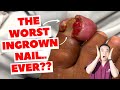 The Worst Ingrown Nail I’ve Seen In 30 YEARS!! - Dr. Kim, Holistic Foot Doctor