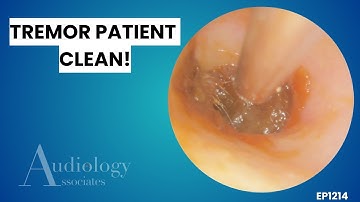 Audioloog verwijdert diepe oorsmeer bij tremorpatiënt - EP1214