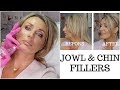 Jowls and Chin Fillers with Before And After Photos - my experience