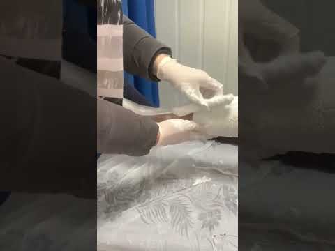 Flat Feet Girl Casting #shorts #prosthetic