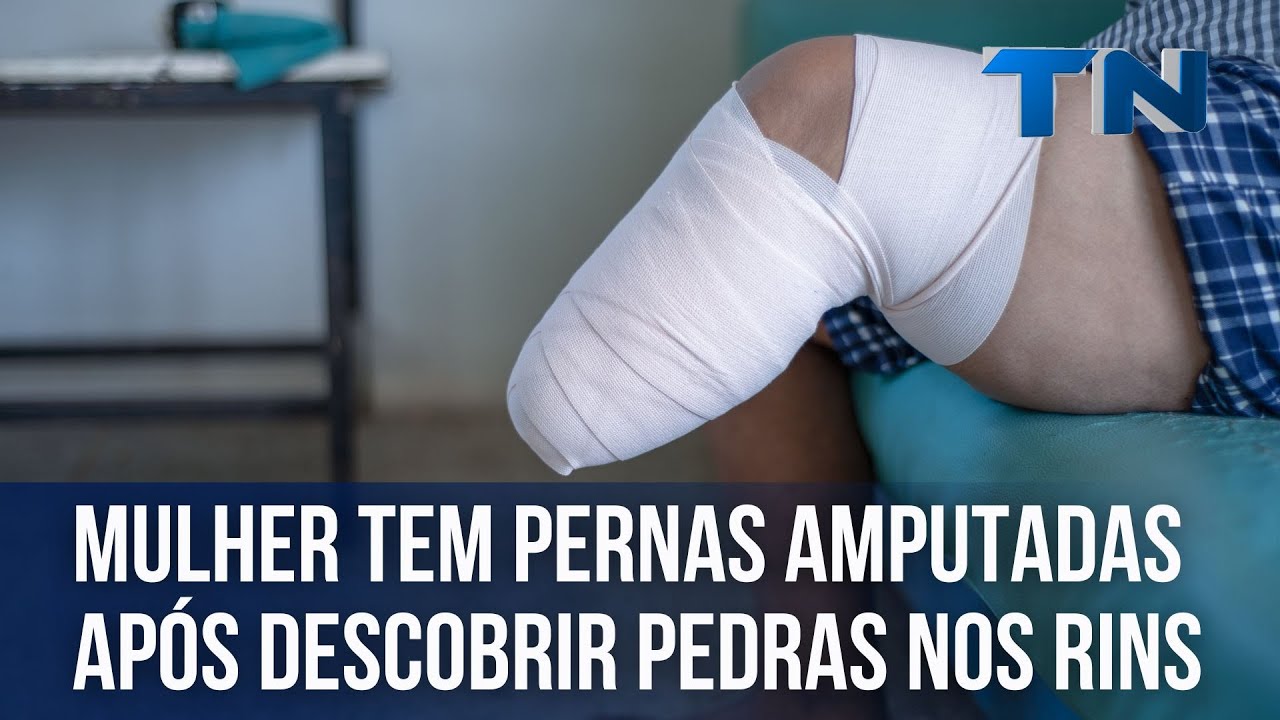 Mulher tem pernas amputadas após descobrir pedras nos rins