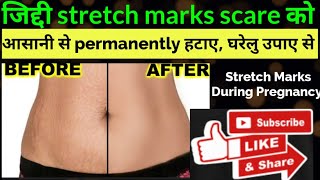 After delivery stretch marks hatane k gharelu upay/ How to Prevent & Remove Stretch Marks at Home