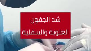 Eyelids lifting (Blepharoplasty) - شد الجفون