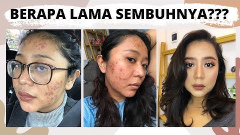 Berapa lama jerawat kecil akan hilang