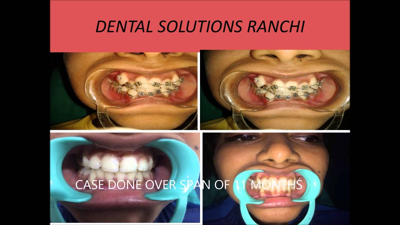 DENTAL SOLUTIONS RANCHI YouTube