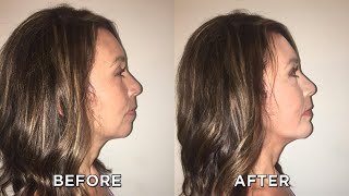 Results of the 5-Minute Non-Surgical Chin Treatment