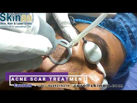 Acne Scar Laser Removal Treatment in India, Jaipur with Fractional Co FDA Approved Laser