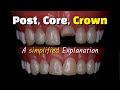 Fixing a broken front tooth with a post core buildup and crown after a root canal