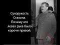 Сухорукость Сталина. Почему его левая рука была короче правой.