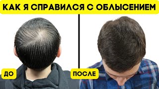 Как я избавился от ОБЛЫСЕНИЯ. Моя история. АГА