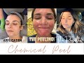 COME GET A CHEMICAL PEEL WITH ME|| the application, day by day progress, and how my skin looks now!