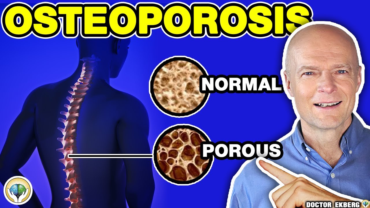 Prevent Osteoporosis Diet Naturally - YouTube