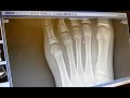 4 broken toes and a broken foot