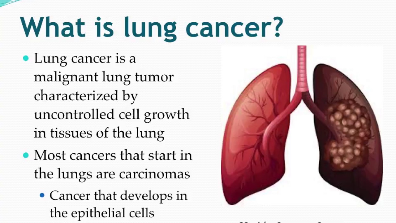 Pics Of Lung Cancer - Lung cancer - Stock Image - M131/0691 - Science