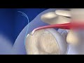 Rotator cuff repair supraspinatus tear animation