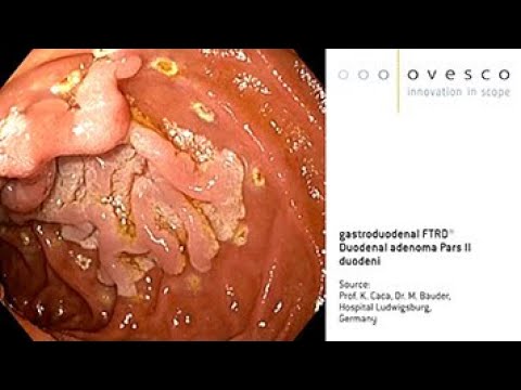 FTRD® System | gastroduodenal FTRD | Resection of a duodenal adenoma in pars II duodeni