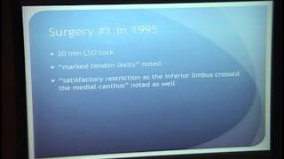 Pediatric Strabismus (Video #2) [ARCHIVE]