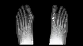 What Kind of Bunion Surgery is Right for Me?