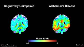 tau PET for cognitive diagnosis