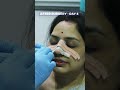 Rhinoplasty for a Lady  - Before &amp; After