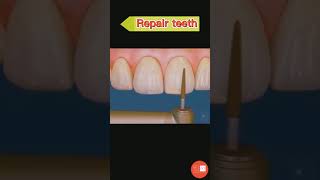 Repair Teeth