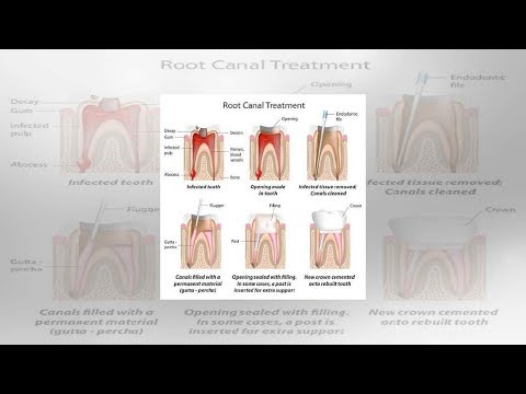 Root Canal Infections: Symptoms, Causes, Treatment, and Prevention | Tita TV