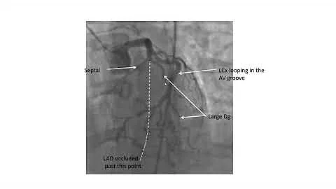 Coronary angiographic views- Elias Hanna