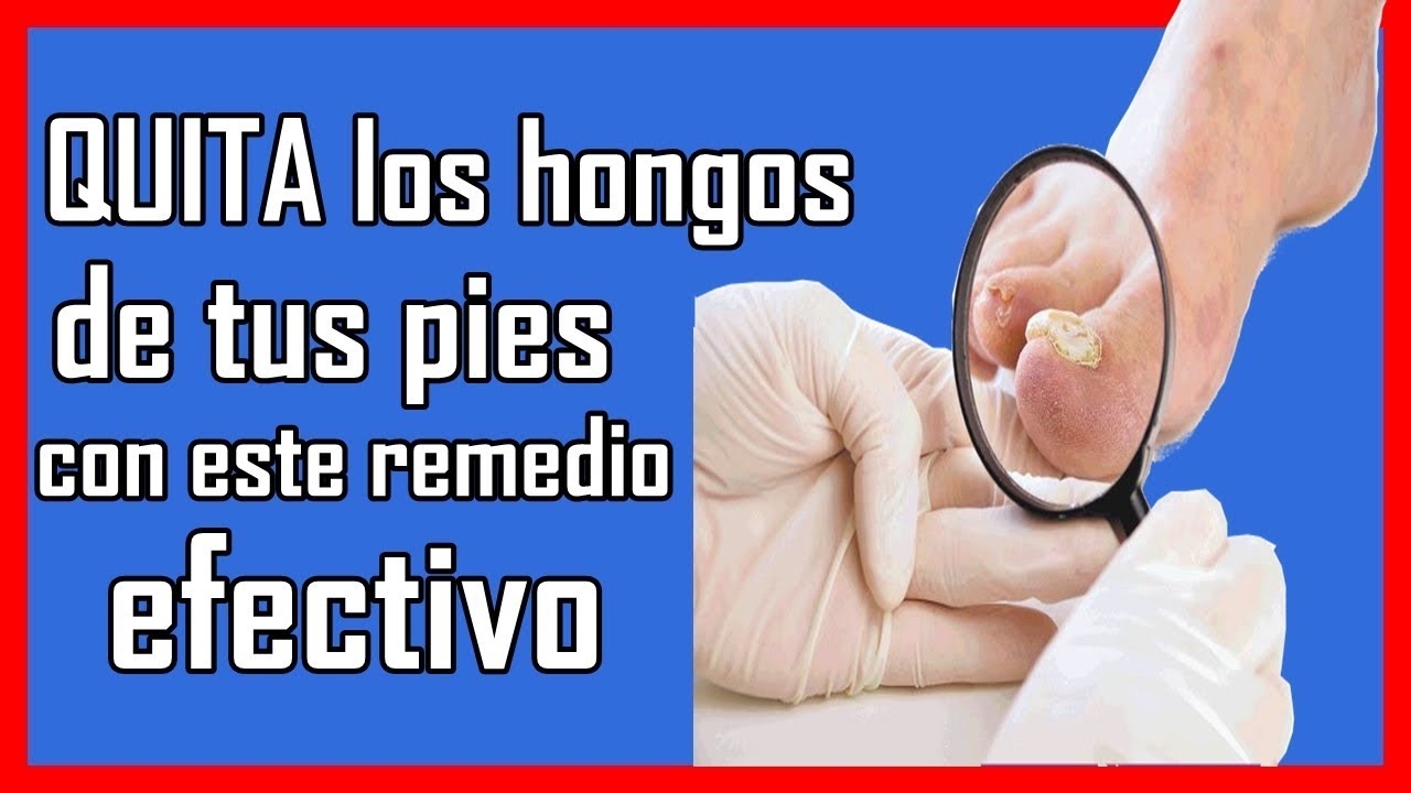 remedios naturales para la artritis Elimina los hongos de las uñas de los pies con algunos de ESTOS ingredientes que tienes en tu cocina