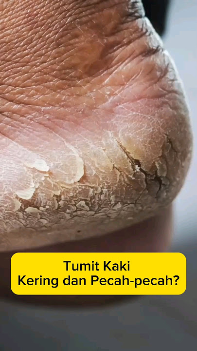 Cara Atasi Tumit Kaki Kasar Dan Pecah - Pecah | Dirmed #shorts #skincare