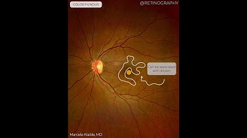 ACQUIRED VITELLIFORM LESION MULTIMODAL ANALYSIS For more images like this visit www.retinography.org