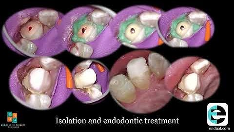 Dental trauma Panorama - Managing a crown-root fracture