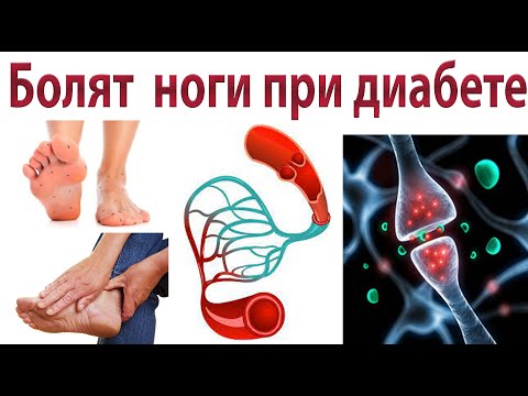 Болят и немеют ноги при диабете. Диабетическая полинейропатия. Как лечить?