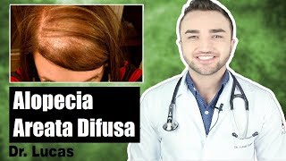 Alopecia Areata Difusa Incognito | Queda de Cabelo Difusa - Dr Lucas Fustinoni
