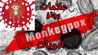 The Shocking Truth Monkeypox Outbreak Prevention Tips and Symptoms world health organization
